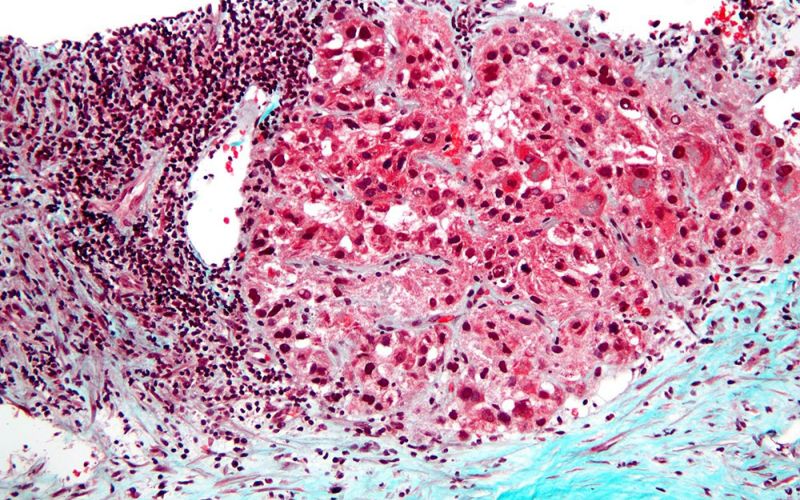 Una grapa molecular’ que ayuda a reparar el ADN roto es una de las causas de la agresividad del cáncer de hígado