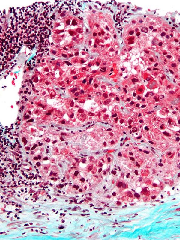 Una grapa molecular’ que ayuda a reparar el ADN roto es una de las causas de la agresividad del cáncer de hígado