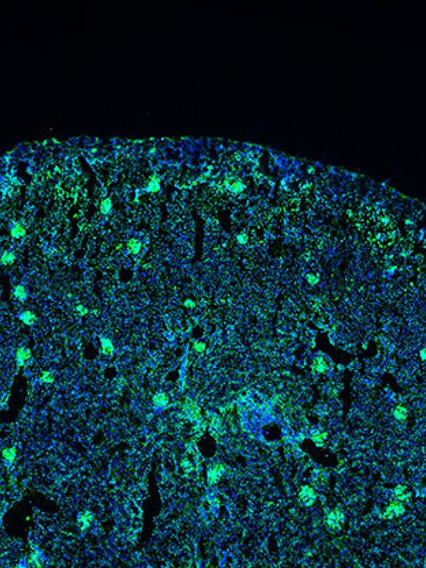Identifican un nuevo marcador para el seguimiento del lupus