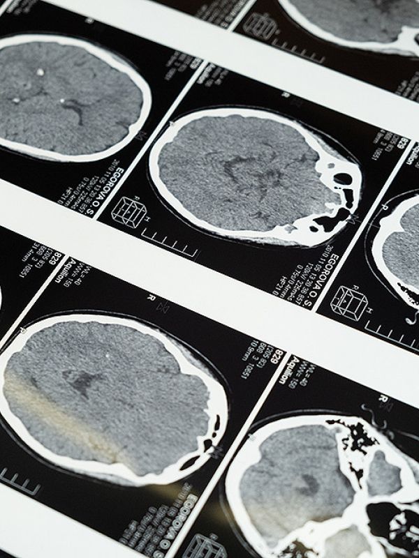 Identifican un nuevo modelo de desarrollo de la corteza cerebral