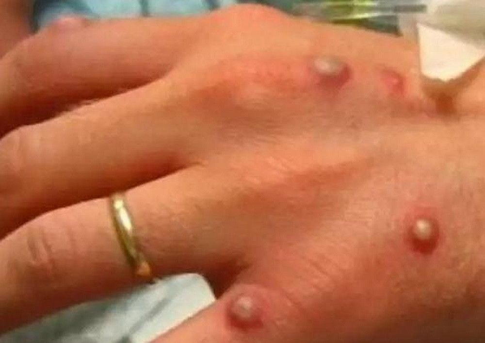 Detectado en la provincia de Málaga un posible caso de infección por viruela de mono