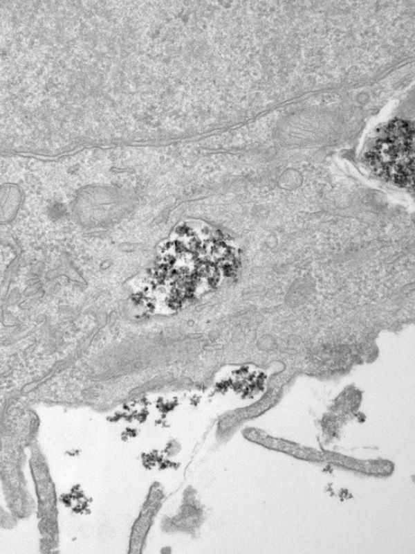 Nanopartículas magnéticas metálicas para liberar fármacos de forma dirigida y para tratar tumores