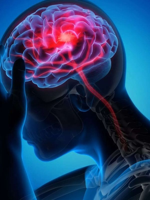 El ictus cerebral mata las neuronas mediante ondas eléctricas letales
