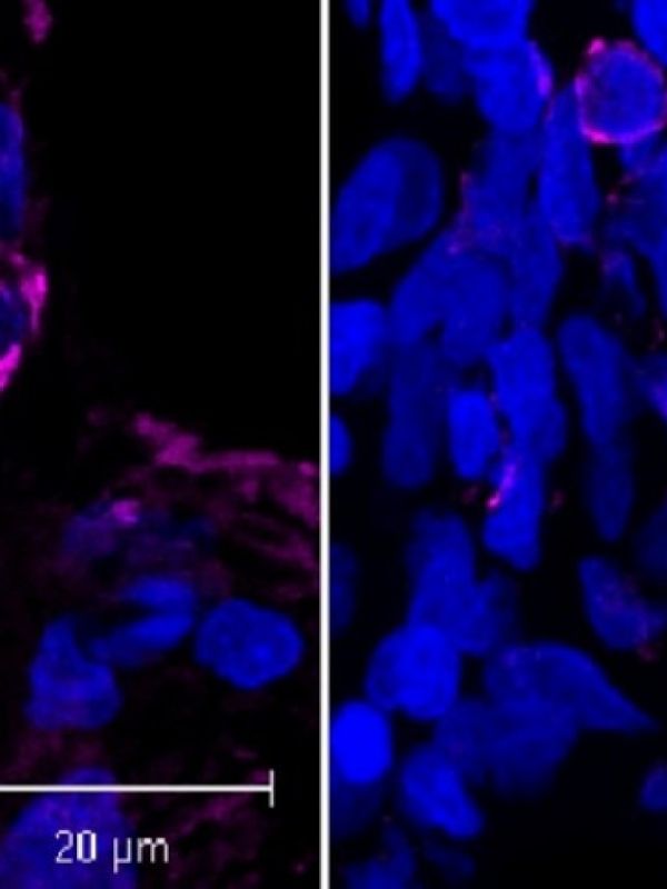 Una nueva terapia utiliza nanopartículas contra la fibrosis pulmonar